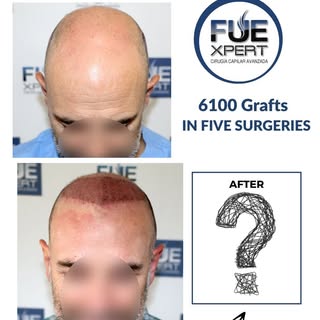Is it possible to restore advanced baldness with a very limited donor area? 🤔👇

Today we’re sharin