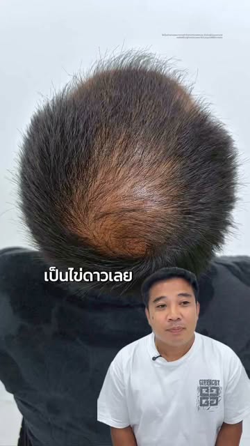 ผมบางเป็นไข่ดาว กลับมาดูหนาขึ้นได้ หลังดูแลด้วย Program BPA ✨💙
�เคสจริงจากผู้รับบริการที่มีปัญหาผมบ