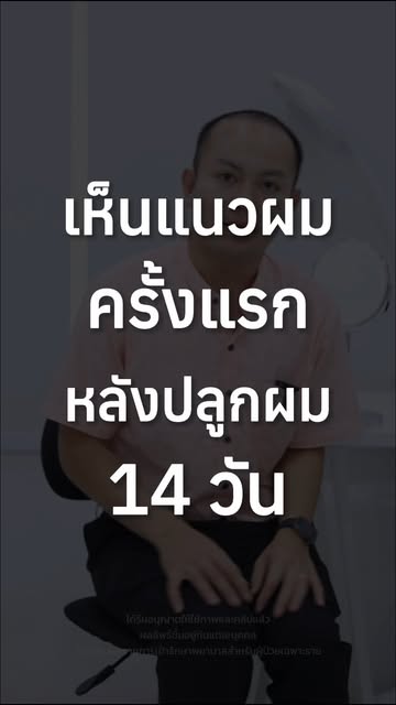 “สวยนะเนี่ย… อุ๊ย! หน้าเปลี่ยนไปเลย” 
วินาทีที่เห็นแนวผมหลังปลูก 14 วัน
ลูกค้าท่านนี้ถึงกับพูดออกมาแ