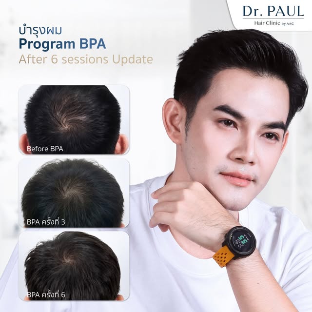 จากผมบาง กลับมาดูหนาขึ้น ✨💙
ผลลัพธ์จริงหลังดูแลด้วย Program BPA ต่อเนื่อง 6 ครั้ง จากเคสที่มีปัญหาผ