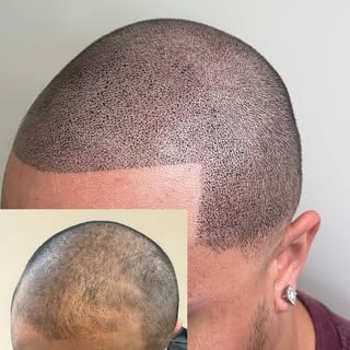 This client got tired of using hair fibers to cover up hair loss and wanted something more permanent