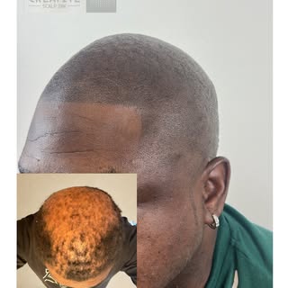 Confidence restored! 🔥

Dealing with hair loss? We’ve for you covered. 

Contact us for more inform