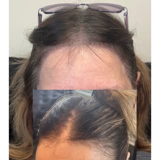 Thinning hair can be frustrating, especially when it starts becoming more noticeable over time. 

Th
