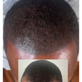 A receding hairline doesn't have to define your look. With this client, we were able to create the l