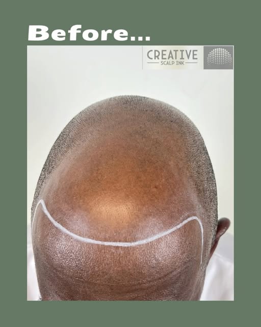 This client was very happy with his results. As you can see, he had some balding on the top of his h