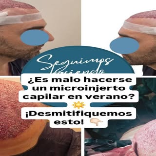 ​¿Es malo hacerse un microinjerto capilar en verano? ☀️ ¡Desmitifiquemos esto!
​Existe la falsa cree