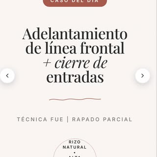 Caso de hoy 👨🏻‍⚕️

Adelantamiento de línea frontal y cierre de entradas.

¿Su objetivo? Adelantar 