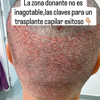 “Doctor, ¿se me va a notar mucho la parte de atrás después de la cirugía?” 🤔 

Es una de las pregun