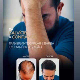 #transplantecapilar #transplantedebarba