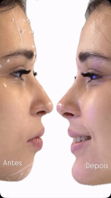 #harmonizacaoorofacial