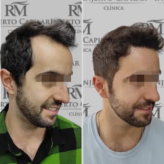 ¡Renovación total con un look natural! 🌟
En Clínica RM Injerto Capilar, estamos comprometidos con o