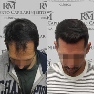 Confía en Clínica AR Injerto Capilar para tu injerto capilar.
Nuestros resultados son nuestra mejor 