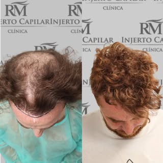 Nuestro paciente no solo ha recuperado su pelo.🔝
✅Imagina verte al espejo como realmente te quieres