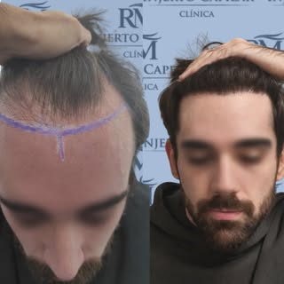 Es tu momento 😘

CLÍNICA RM INJERTO CAPILAR
Sevilla
C/ Antonia Díaz, 12. Cp. 41940, Tomares (Sevill
