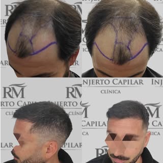 ✨Revela tu mejor versión con Clínica RM Injerto Capilar👨‍⚕️✨
¡Mira el antes y el después en nuestra