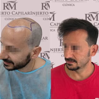 En la Clínica RM Injerto Capilar, estamos comprometidos a devolver la confianza a nuestros pacientes