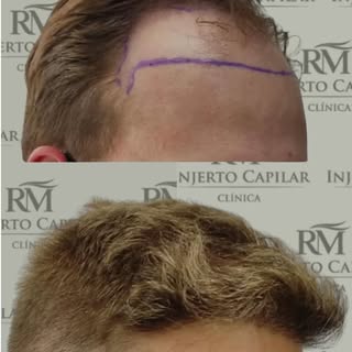7 meses después del injerto capilar ✨

El cabello ya empezó a ganar densidad y forma.
El crecimiento