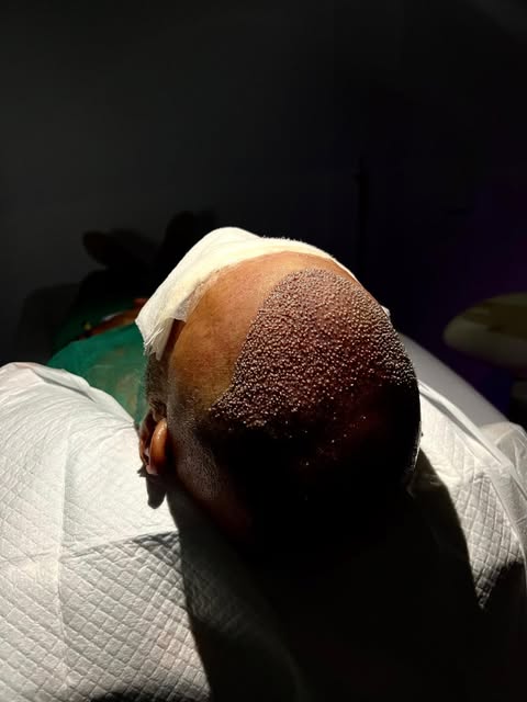 Así finalizamos una nueva intervención de trasplante capilar en RM Injerto Capilar, mostrando el res