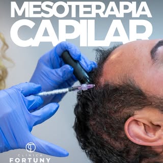 La mesoterapia capilar es una de las opciones más versátiles para tratar la caída y el adelgazamient