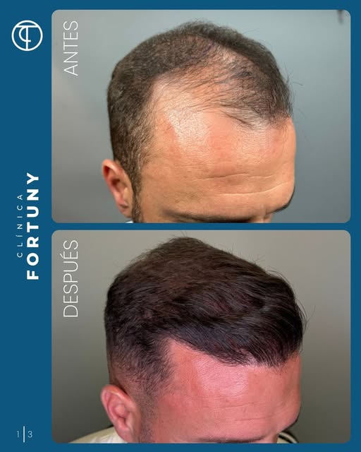 10 meses después de la intervención, el resultado muestra una zona frontal completamente cubierta, c