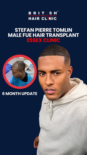 🔥 6 MONTHS OF PROGRESS 🔥 @itsstefan 

Stefan has made incredible progress since having his hair tr