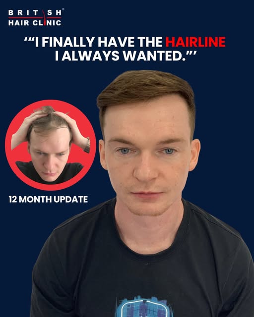 “I finally have the hairline I always wanted — now it’s time to enjoy it.” 🙌 Anthony Morton

12 mon