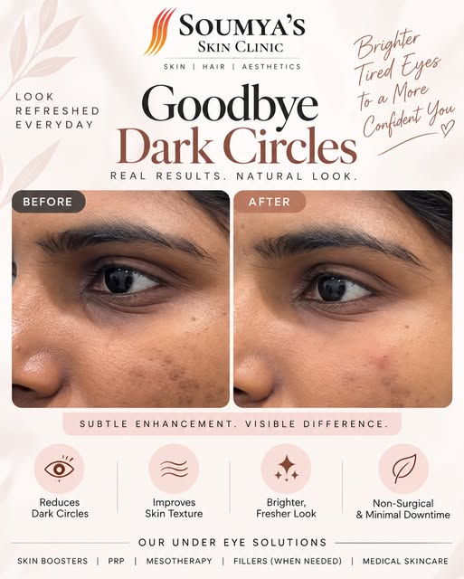 ✨ Under-Eye Fillers | Before & After

A refreshed look without changing your natural features. 🤍

T