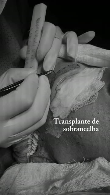 Esta semana realizamos um transplante de sobrancelha, mais cheias e naturais, fio a fio.

O transpla