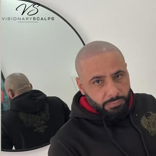 Before or after ? 👀

After 2 failed hair transplants he researched into SMP. And it was the best de
