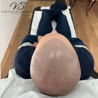 SMP or hair?

here at VisionaryScalps we deal in realism. Our scalpmicropigmentation is so natural l