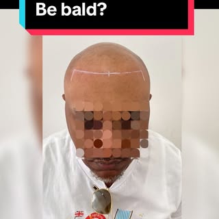 Would you rather be bald ?

I know I wouldn’t 

SMP gives the impression of a short hair cut . We ca