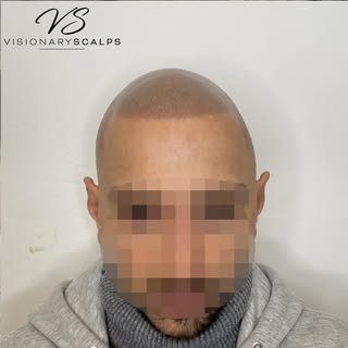 Bald or bold ?💯

It’s your choice . SMP or a hair tattoo can change your appearance and life 🎉

To
