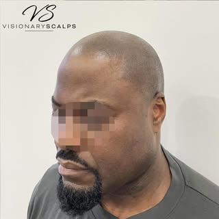 SMP or hair ? 

Here at visionary scalps our aim is to create realistic natural looking results. We 