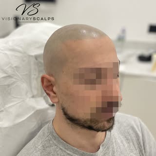 Our client came to us with these requirement : Natural and undetectable . How did we do? 

To book a