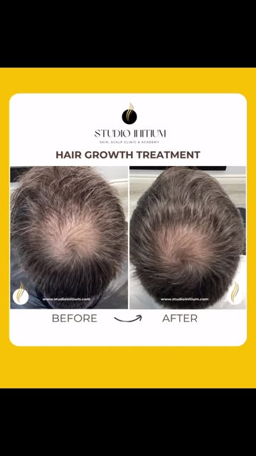 Male androgenetic alopecia (AGA) is progressive but when detected early, with consistent care and a 