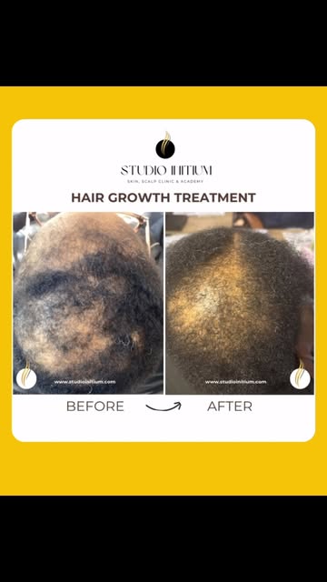 Scarring alopecia is more than hair thinning. Conditions such as CCCA and traction alopecia can perm