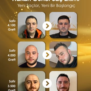 Saç ekimi uygulamalarımızda hedefimiz;
doğal görünüm ve maksimum sıklık hissi oluşturmaktır.

Safir,