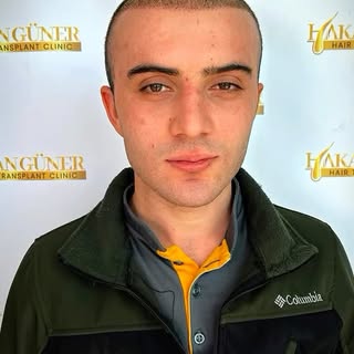 4200 greft ile, yüz hatlarına uyumlu ve doğal bir saç çizgisi tasarlandı.
Safir Micro  tekniği ile y