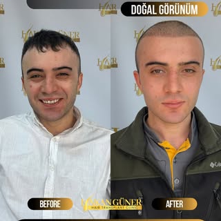 Micro Safir tekniğiyle yapılan 4.200 greft saç ekimi uygulamasında,
saç yapısına uygun planlama ile 