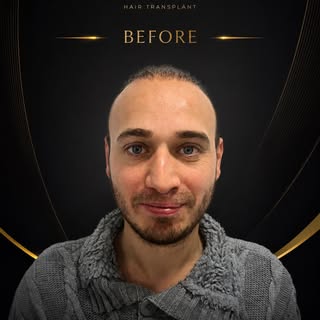 Her başarılı saç ekiminin temelinde doğru planlama vardır.

Bu hastamız için saç çizgisi tasarımı, g