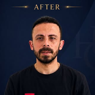 ✨ Doğal saçlarınıza kavuşmak artık mümkün.

Saç ekimi sonrası elde edilen bu doğal ve yoğun görünüm,