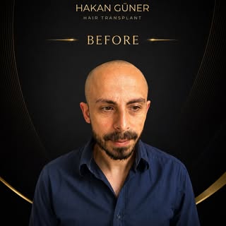 Saç ekiminde doğal ve kalıcı sonuçlara ulaşmanın ilk adımı, kişinin saç yapısına, donör alanına ve y