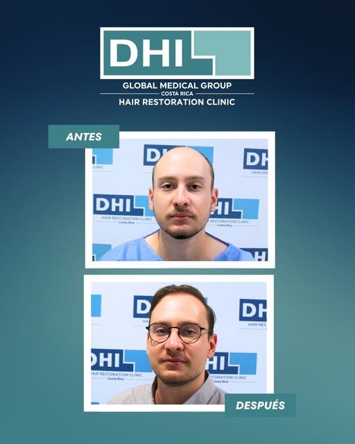 Perder el cabello a una edad temprana es algo que pocos hablan abiertamente, pero que afecta más de 