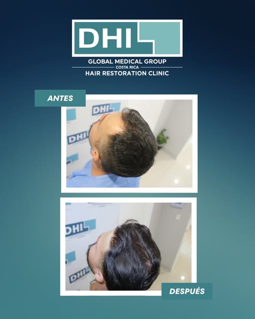 ¿Estás cansado de la pérdida de cabello?  Mira este impresionante antes y después y comprueba que la