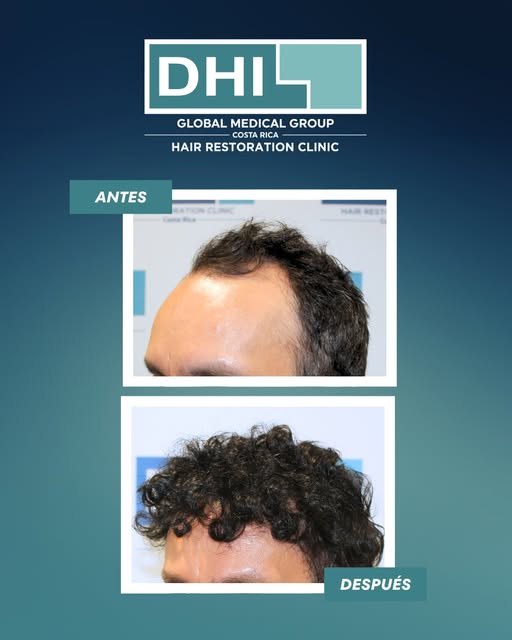 Este es un antes y después real. No hay filtro ni ángulo que ayude. Una transformación permanente.
S