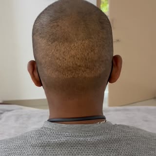 You might recognise these scars. If you’ve had a hair transplant, you probably know the ones — visib