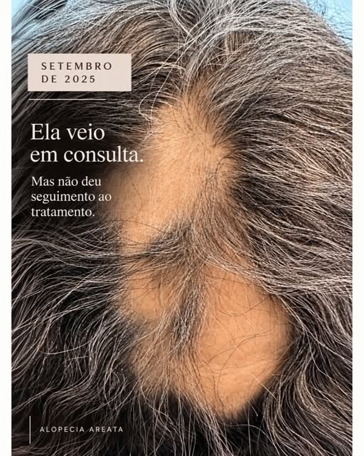 Ela não percebeu a piora.
O marido percebeu primeiro.
Enquanto ela lavava o cabelo, ele viu uma plac