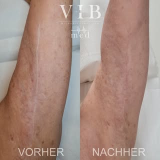 | MEDIZINISCHE PIGMENTIERUNG |

Nach Schönheitsoperationen können Narben sichtbar bleiben.
Bei VIB a