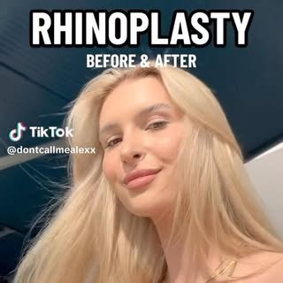 Thank you to our gorgeous patient for showcasing her surgical journey! 💙 It’s amazing to see our pa