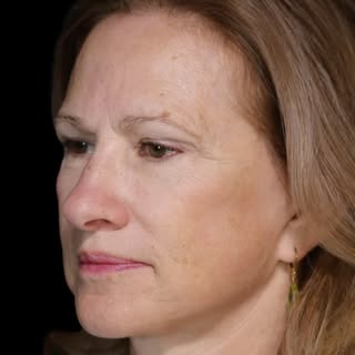 Excited to share this update of our facelift patient who’s now two years post surgery! 

Surgeon: @d